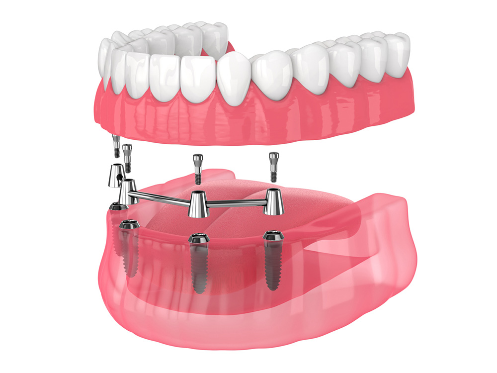 Dentist_Ashburn_VA_All-On-4-Dental-Implants Dentist_Ashburn_VA_All-On-4-Dental-Implants