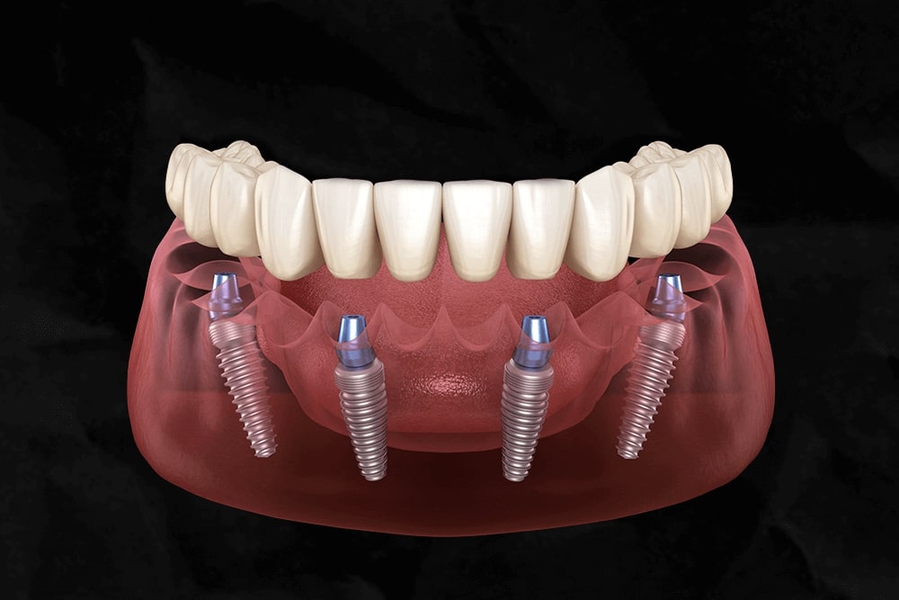 Dentist_Ashburn_VA_All-on-4-Dental-Implants_Model Dentist_Ashburn_VA_All-on-4-Dental-Implants_Model