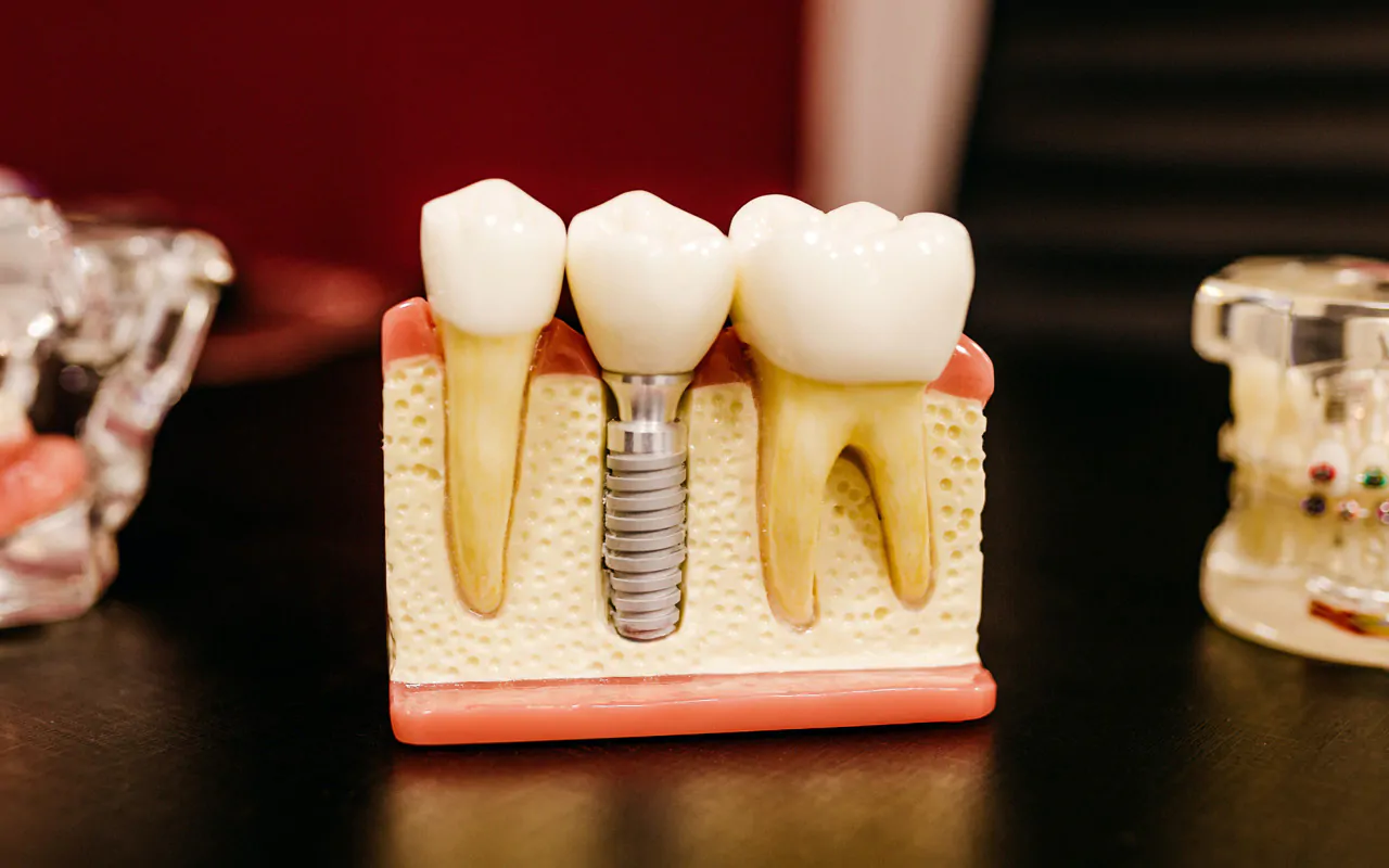 Dentist_Ashburn_VA_Bone_Volume Dentist_Ashburn_VA_Bone_Volume