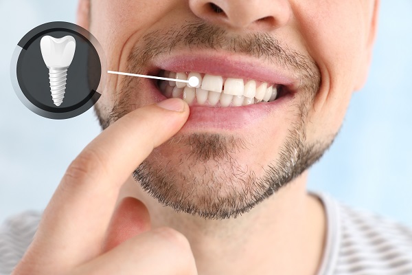 Dentist_Ashburn_VA_Candidate-for-Dental-Implants Dentist_Ashburn_VA_Candidate-for-Dental-Implants