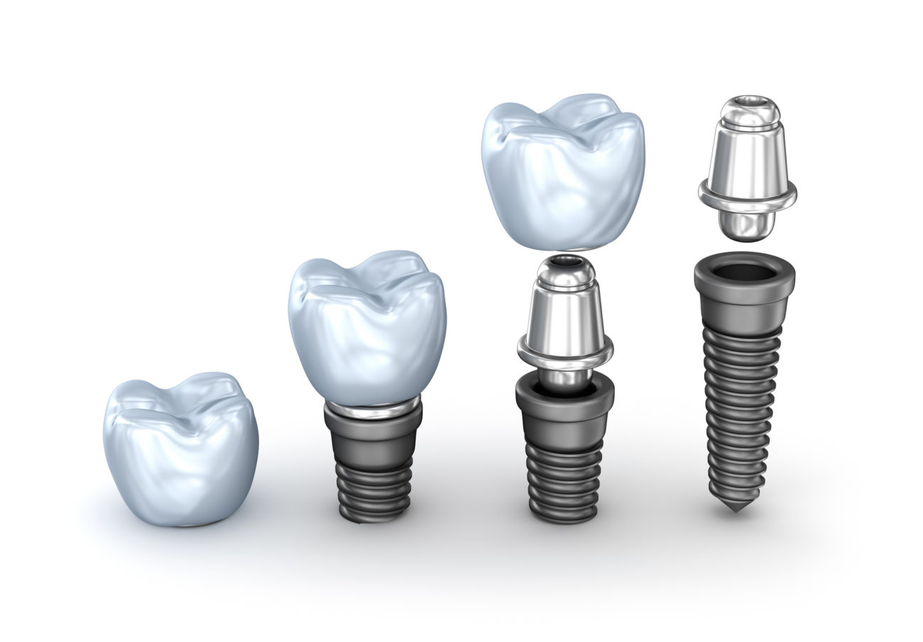 Dentist_Ashburn_VA_Dental_Implant_parts Dentist_Ashburn_VA_Dental_Implant_parts
