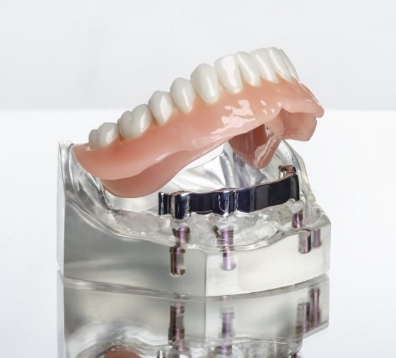 Dentist_Ashburn_VA_implant-dentures Dentist_Ashburn_VA_implant-dentures