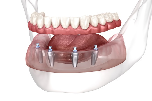 Dentist_Ashburn_VA_Implants_Types Dentist_Ashburn_VA_Implants_Types